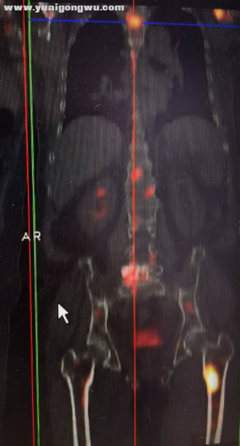 股骨转移到骨髓内